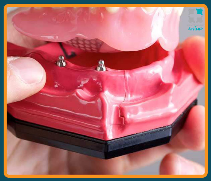 مینی ایمپلنت چیست؟