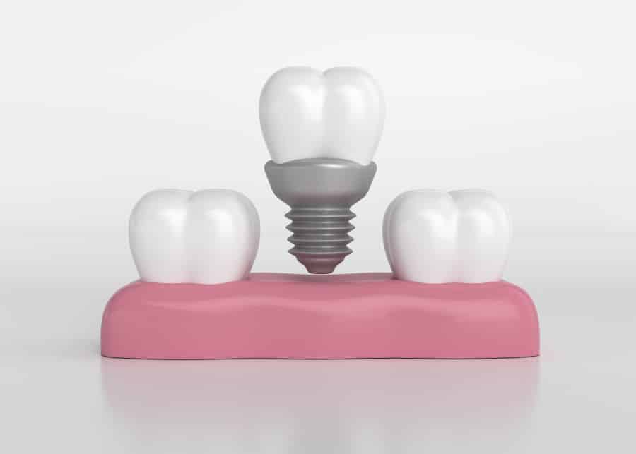 کشیدن دندان و کاشت ایمپلنت