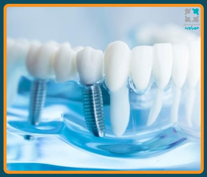 زیبایی ایمپلنت دندان