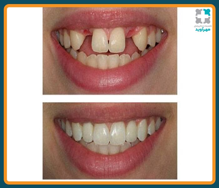 ایمپلنت دندان مصنوعی به نظر می رسد یا طبیعی؟