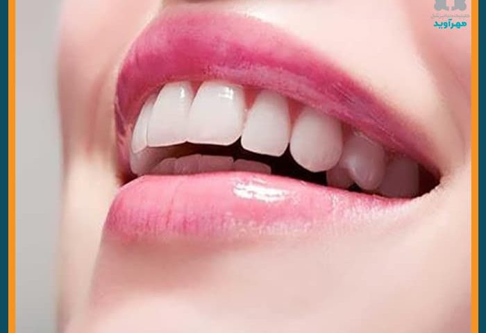 زیبایی ایمپلنت دندان