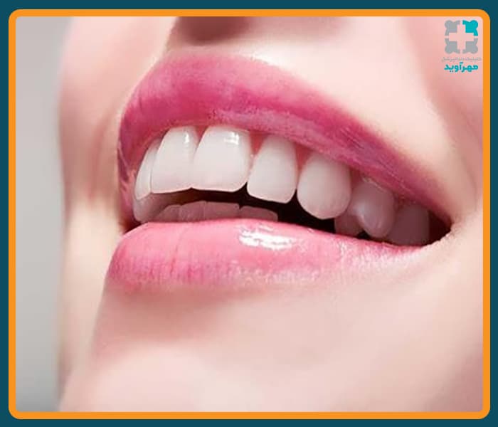 زیبایی ایمپلنت دندان