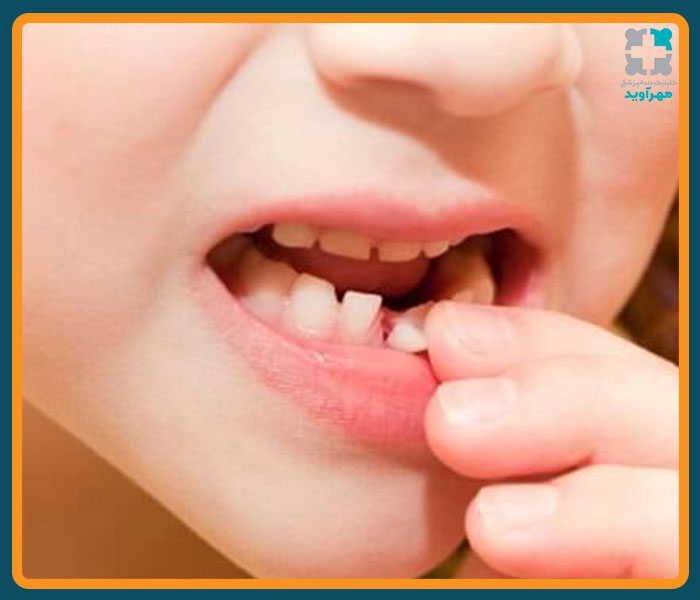 نکات مهم برای مراقبت از دندان کودک