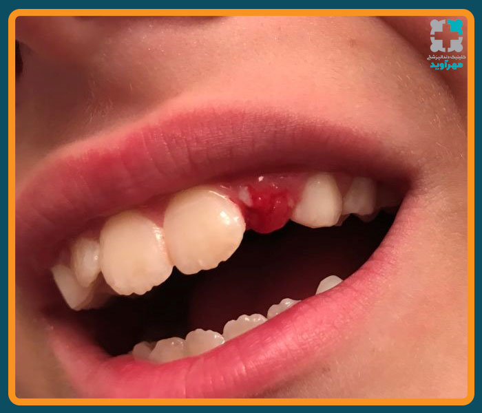 برای مراقبت از دندانهای کودک چه باید کرد؟