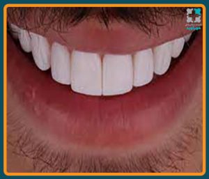 انواع لمینت دندان