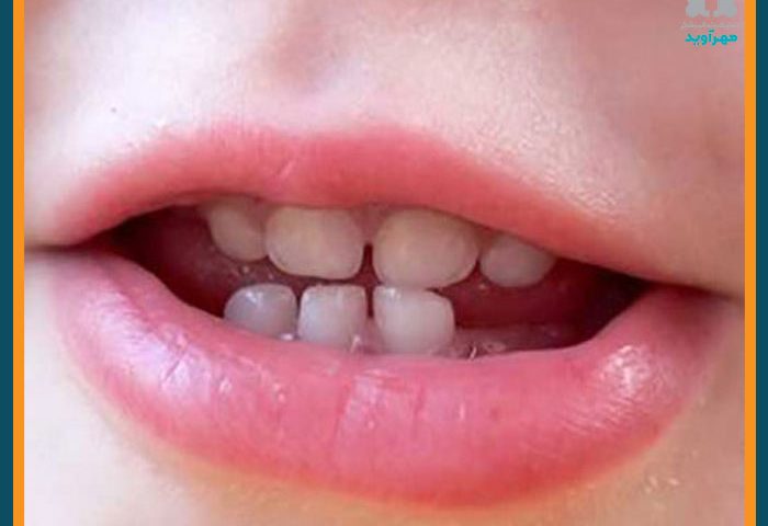 دندان های شیری کودکان