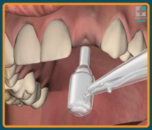 ایمپلنت پانچی