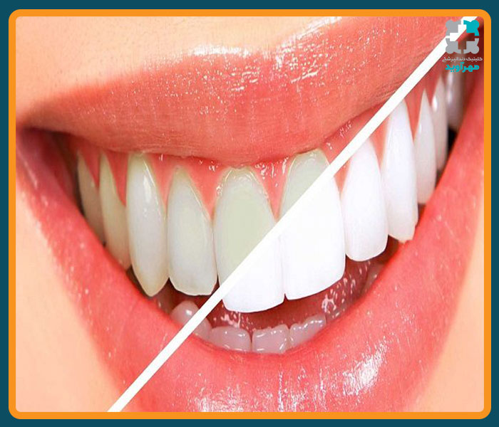 روشهای سفید کردن دندانها