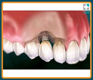 عکس عفونت ایمپلنت