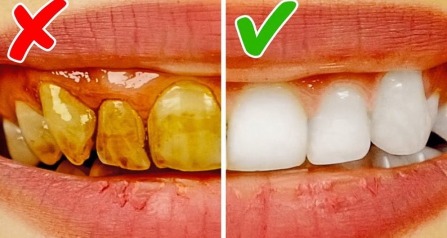 سریع ترین روش سفید شدن دندان
