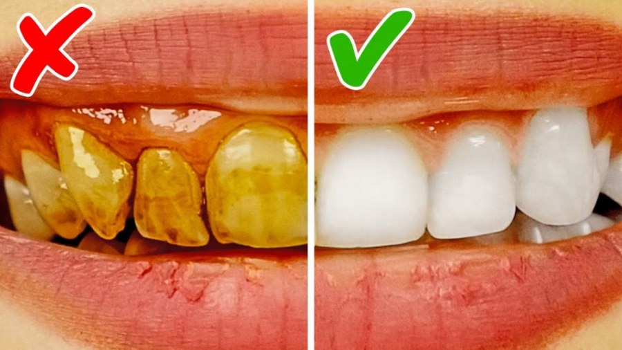 سریع ترین روش سفید شدن دندان
