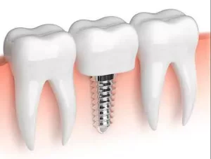 اول ارتودنسی یا ایمپلنت؟