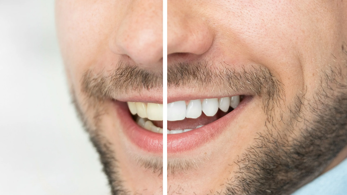 چگونه دندان هایمان را سفید کنیم