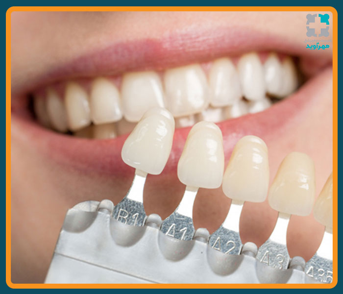 نکات ونیر دندان
