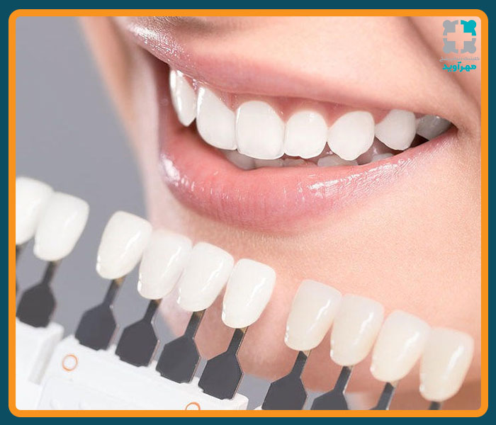 طول عمر کامپوزیت دندان