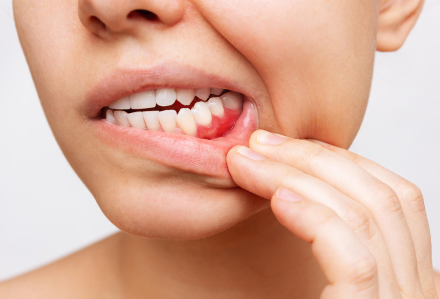 خونریزی دهان