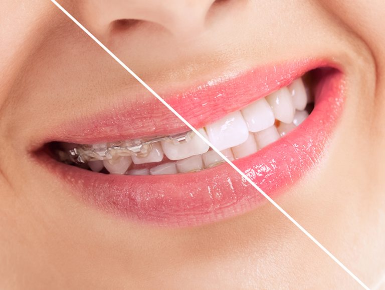 نتیجه ارتودنسی دندان