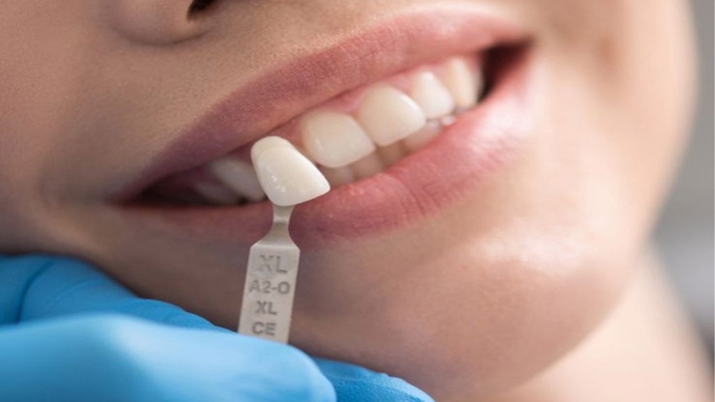 بلچینگ دندان