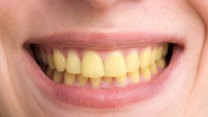 دلایل زرد شدن دندان