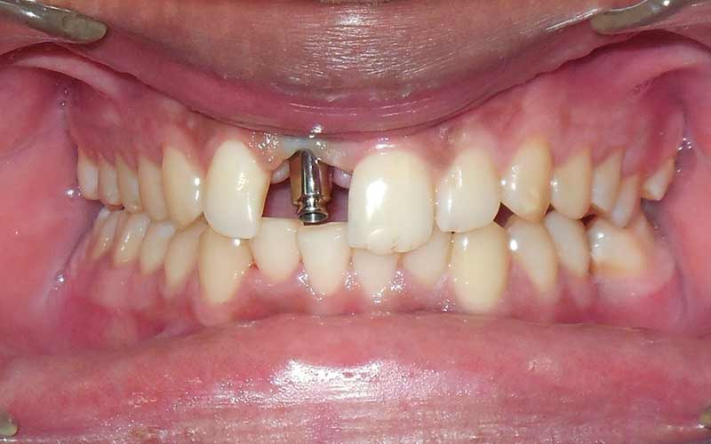 تاثیر ایمپلنت بر سایر دندان ها