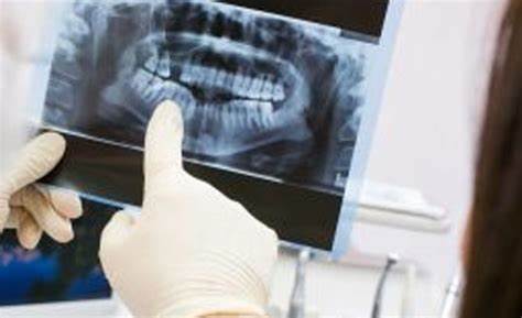 عکس رادیولوژی دندان