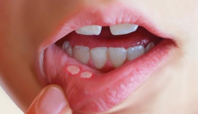 درمان آفت دهان