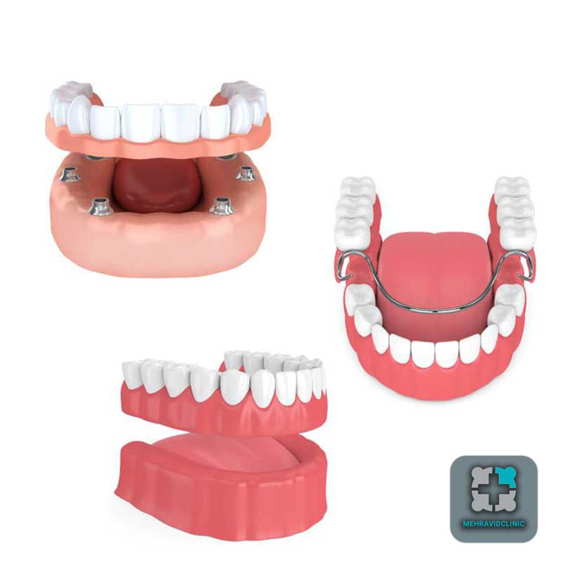 پروتز دندان ثابت