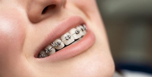 غذاهای ارتودنسی