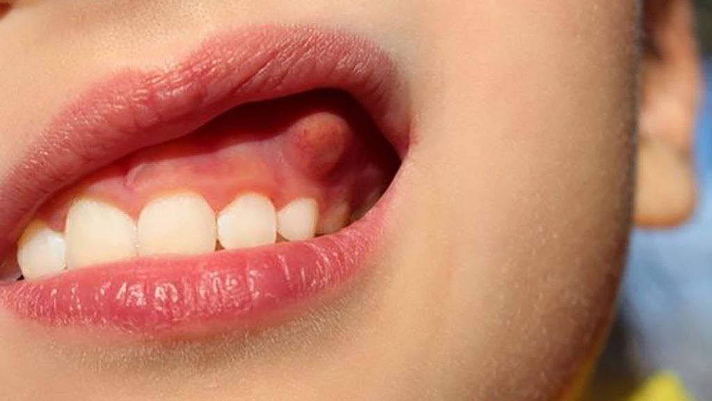 آبسه دنداان