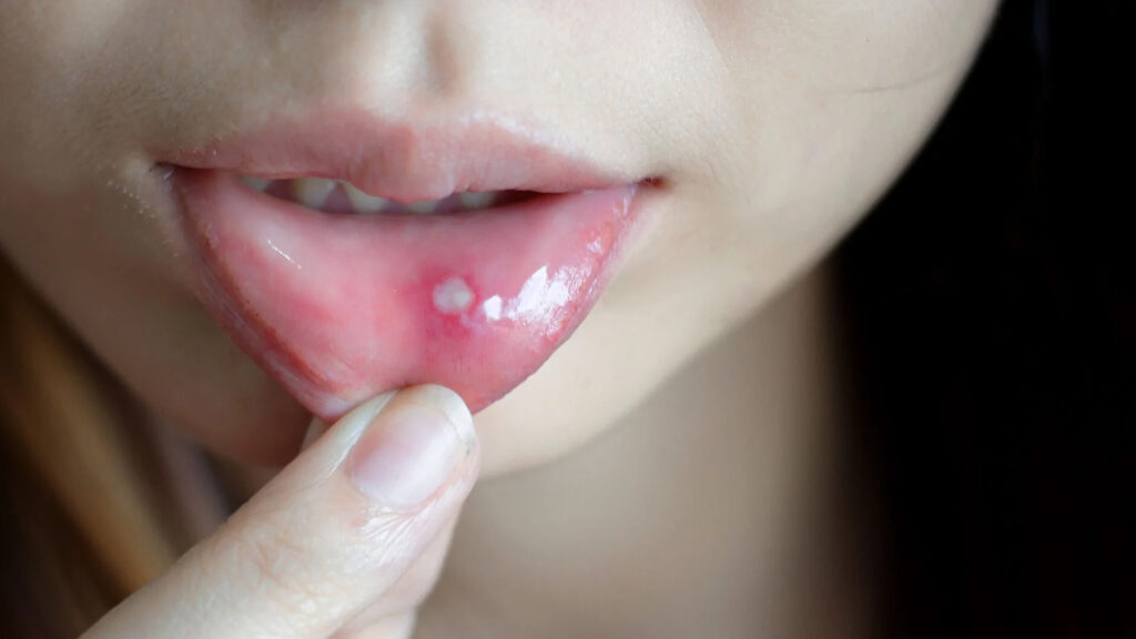 درمان آفت دهان
