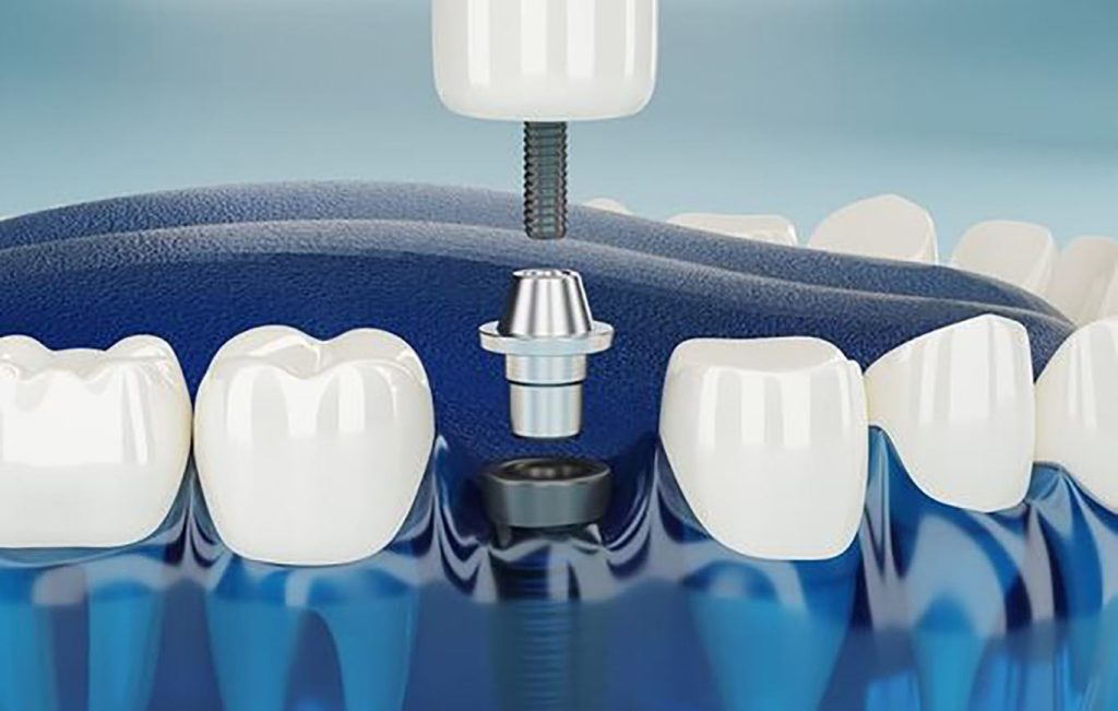 مواد ایمپلنت