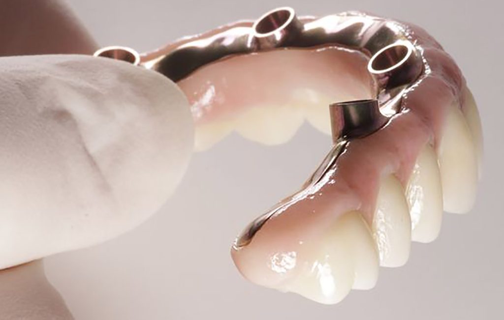 ایمپلنت دندان