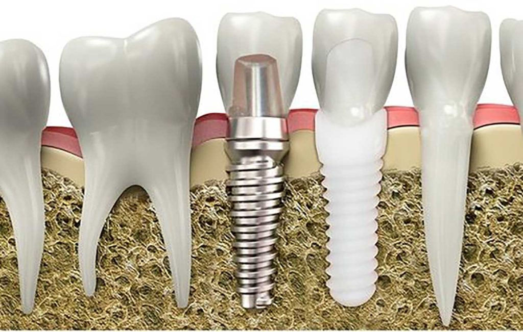 جوش نامناسب استخوان