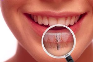 علت لق شدن امپلنت دندان