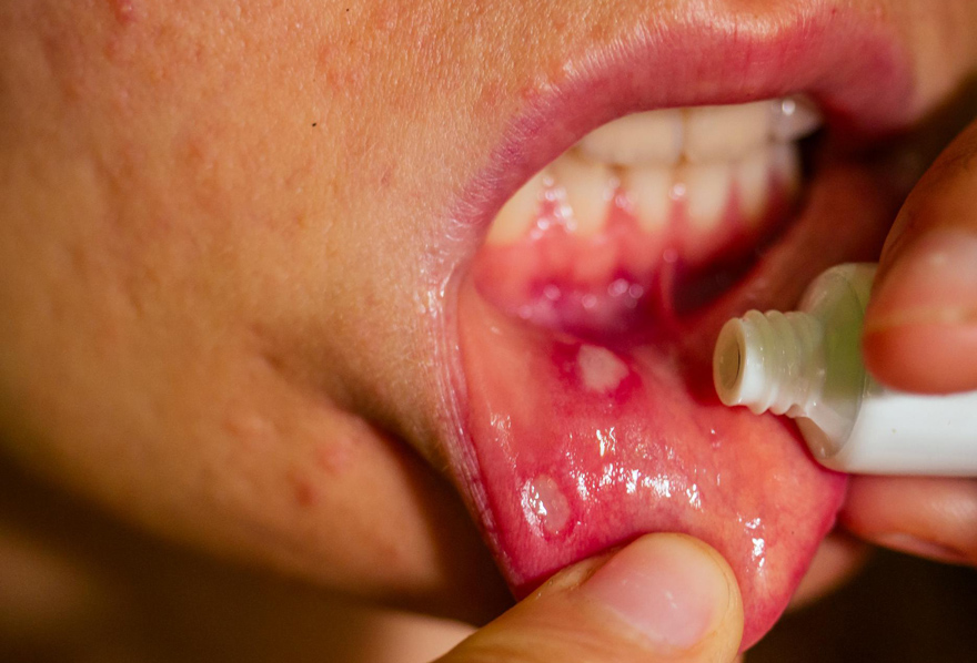 آفت دهان: دلیل درد لثه