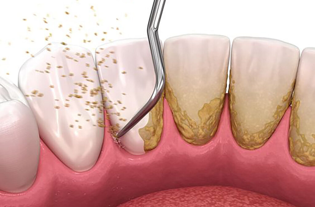 علت پلاک دندان