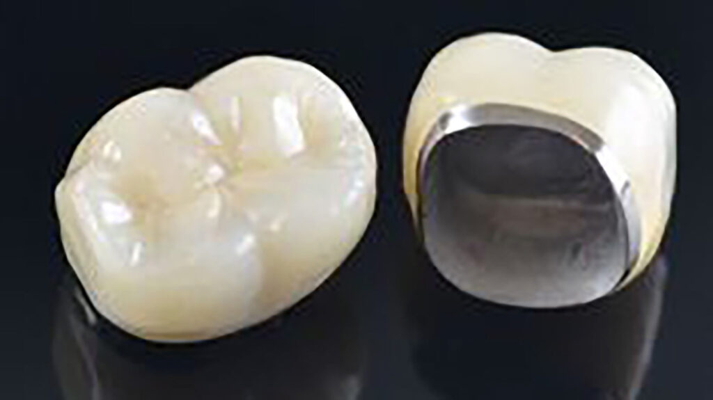 کاربرد روکش دندان