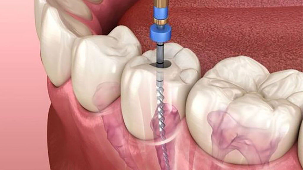 روش عصب کشی دندان