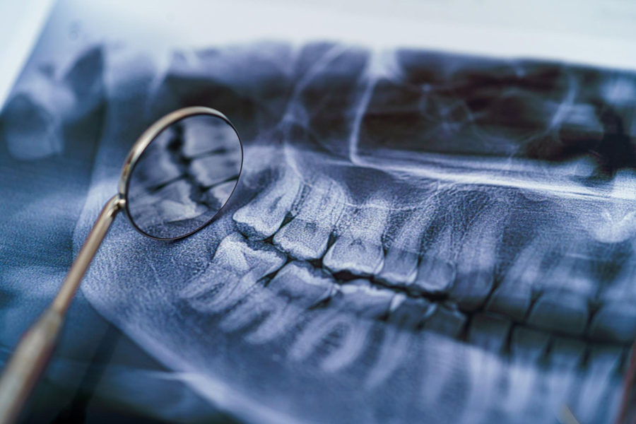 پیوند استخوان فک بالا