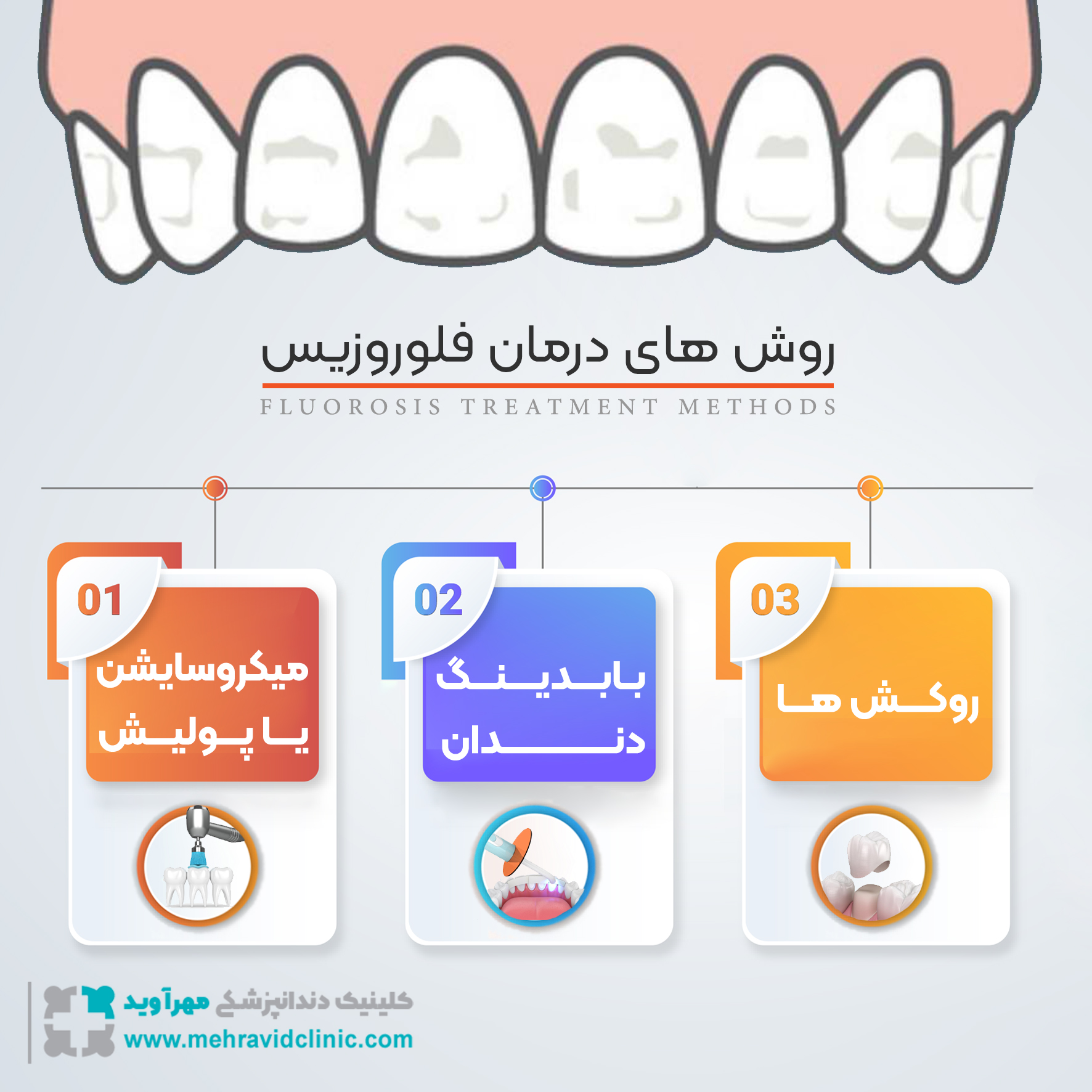 درمان فلوروزیس دندان