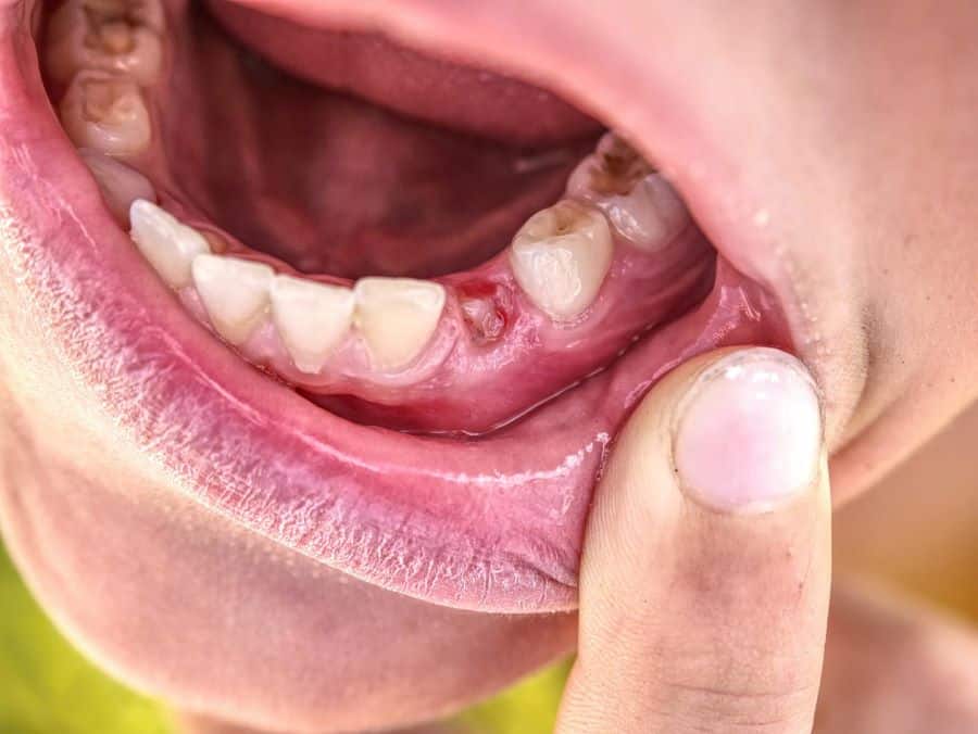 کیست پری آپیکال