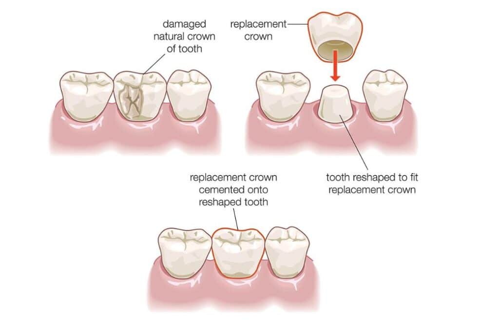 عکس روکش دندان