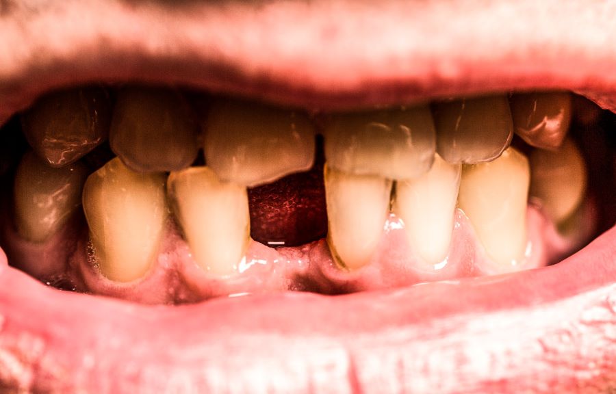 آیا کیست دندان خطرناک است؟