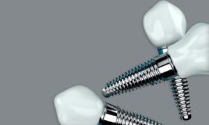 فیکسچر ایمپلنت