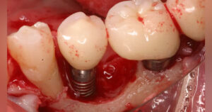 ایمپلنت دندان باعث سرطان میشود؟