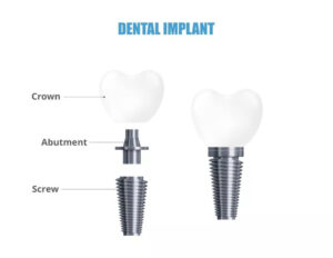 اجزای ایمپلنت دندان