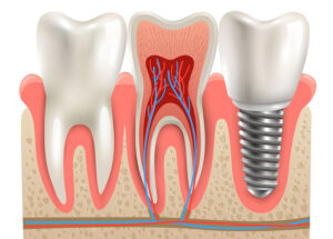 سن ایمپلنت دندان