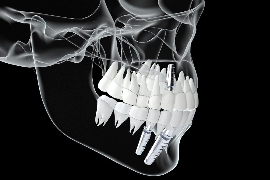 زود جوش خوردن ایمپلنت