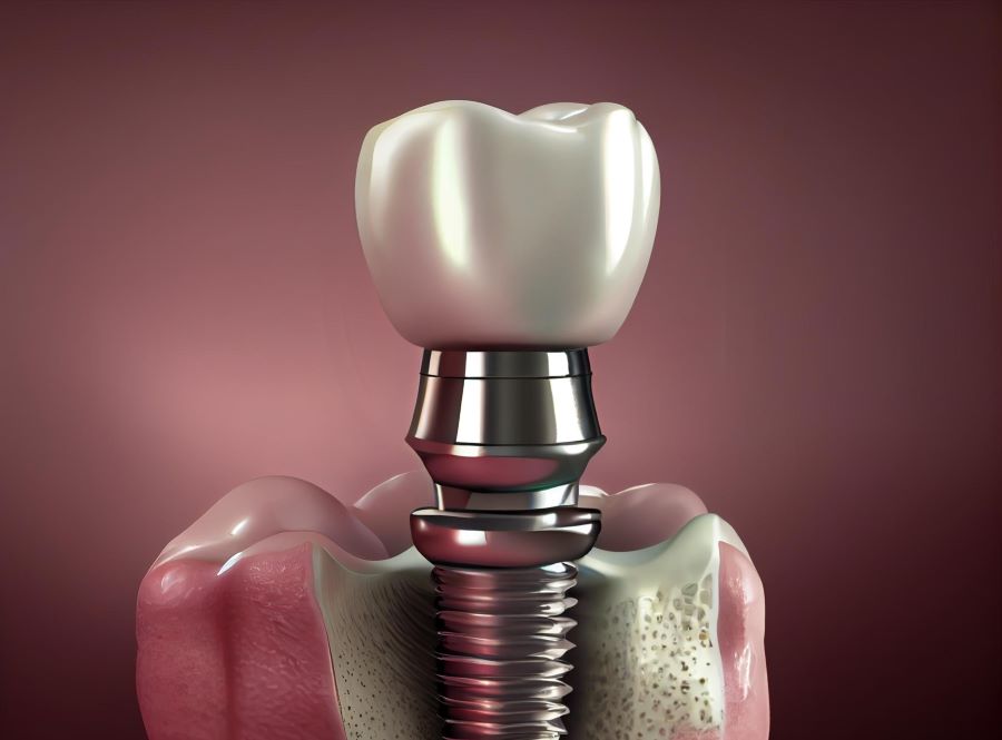 مدت زمان جوش خوردن ایمپلنت