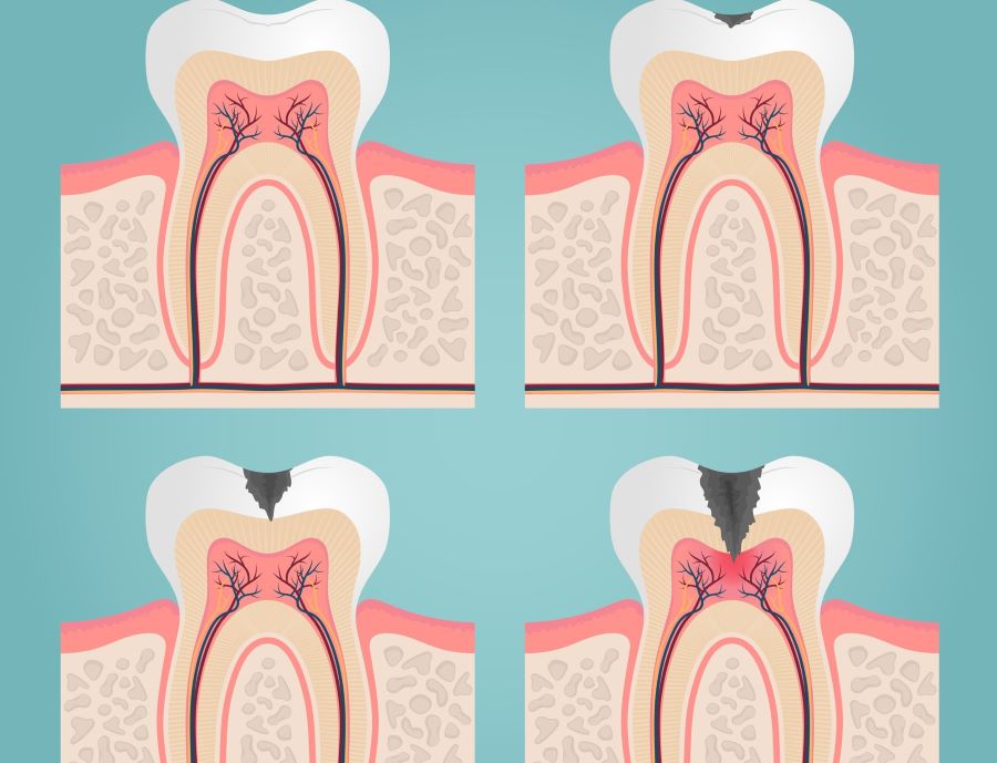 انوع ترک دندان
